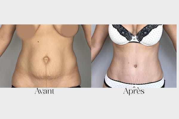 avant après abdominoplastie