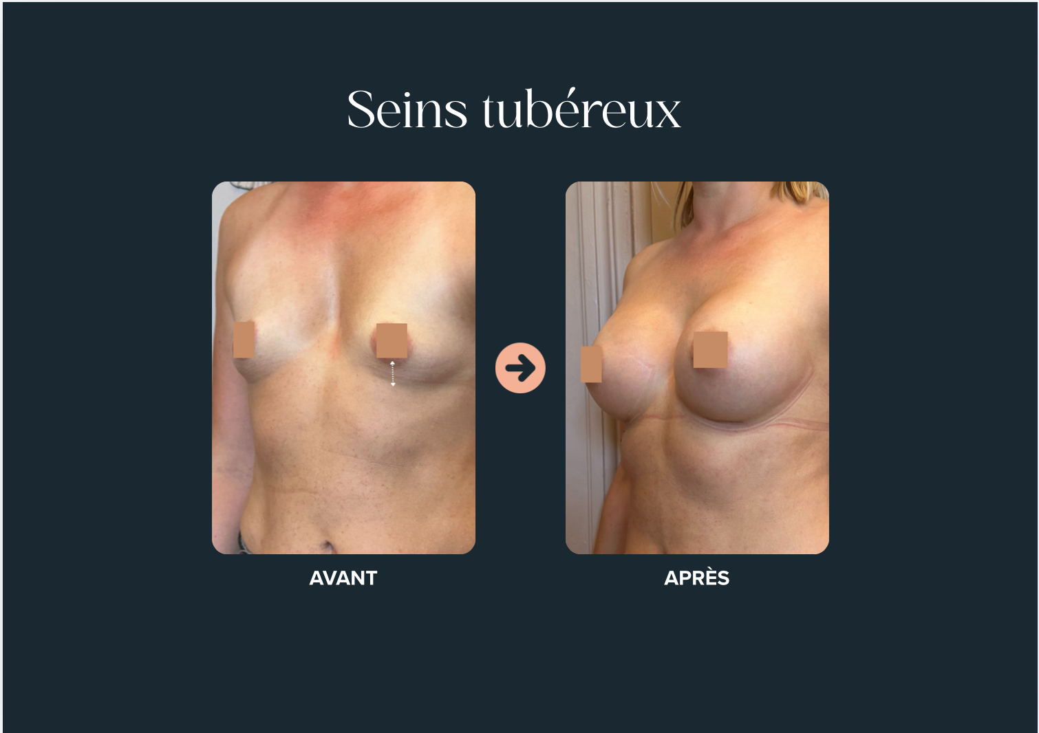 seins tubéreux causes et solutions | Dr. Mertens