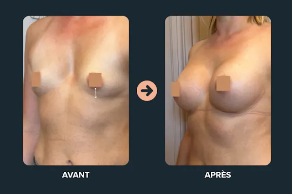 évolution d'une augmentation mammaire