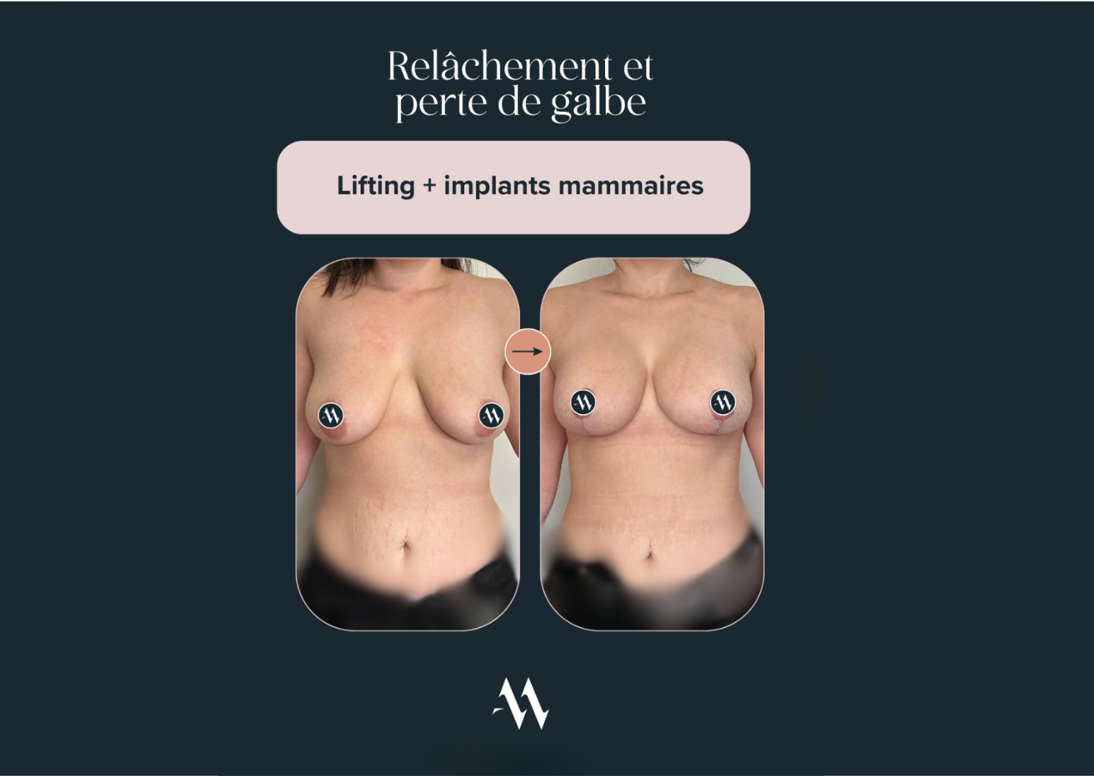 résultat lifting mammaire et implant | Dr. Mertens spécialiste du sein