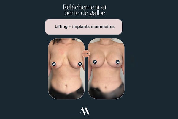 résultat lifting mammaire et implant | Dr. Mertens spécialiste du sein