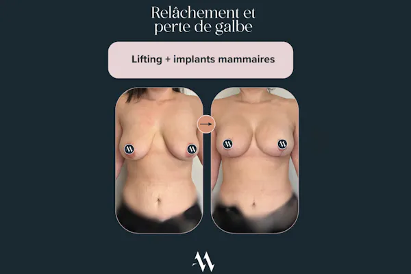 mastopexie avec prothèses à Lyon