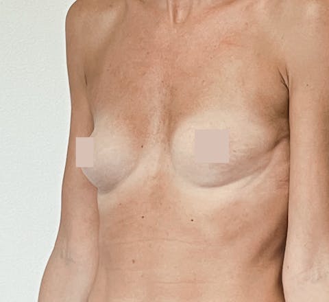 Avant apres pose de protheses mammaires Augmentation mammaire par implants