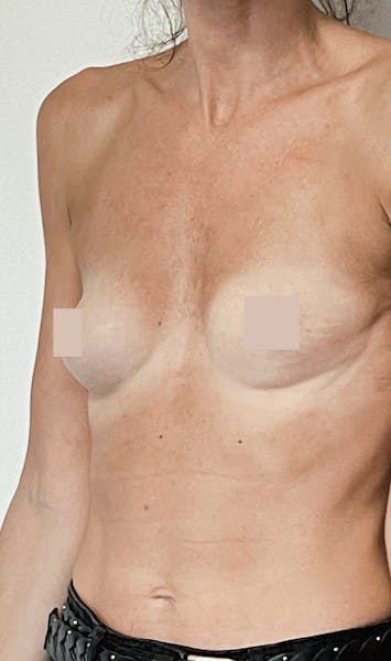 Augmentation mammaire par lipofilling avant