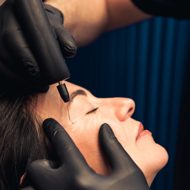 Les fils tenseurs par le Dr. Alexandre Mertens à Lyon Vienne