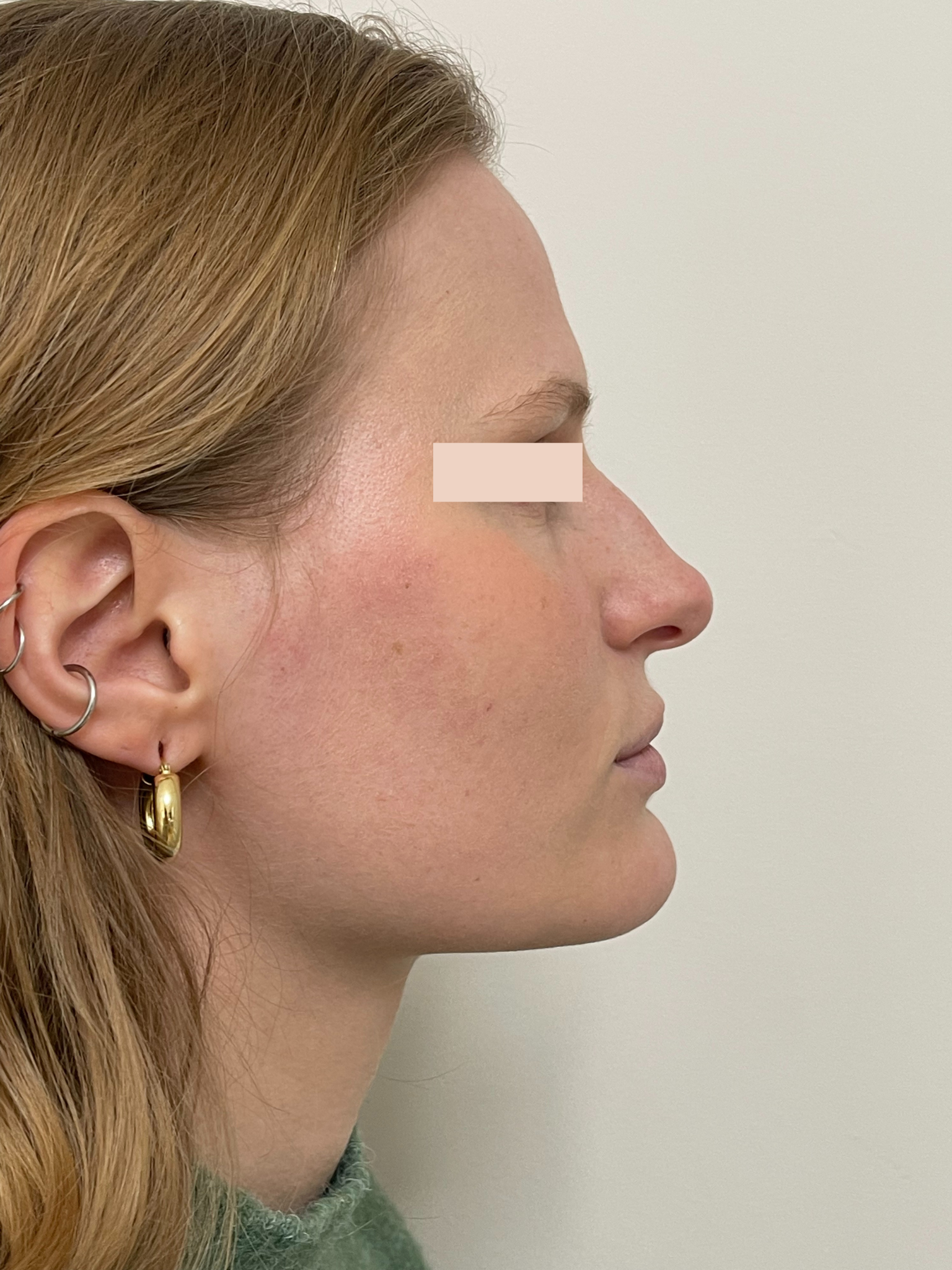 Avant rhinoplastie médicale par le Dr. Alexandre Mertens