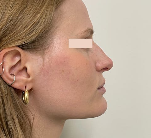 Avant rhinoplastie médicale par le Dr. Alexandre Mertens