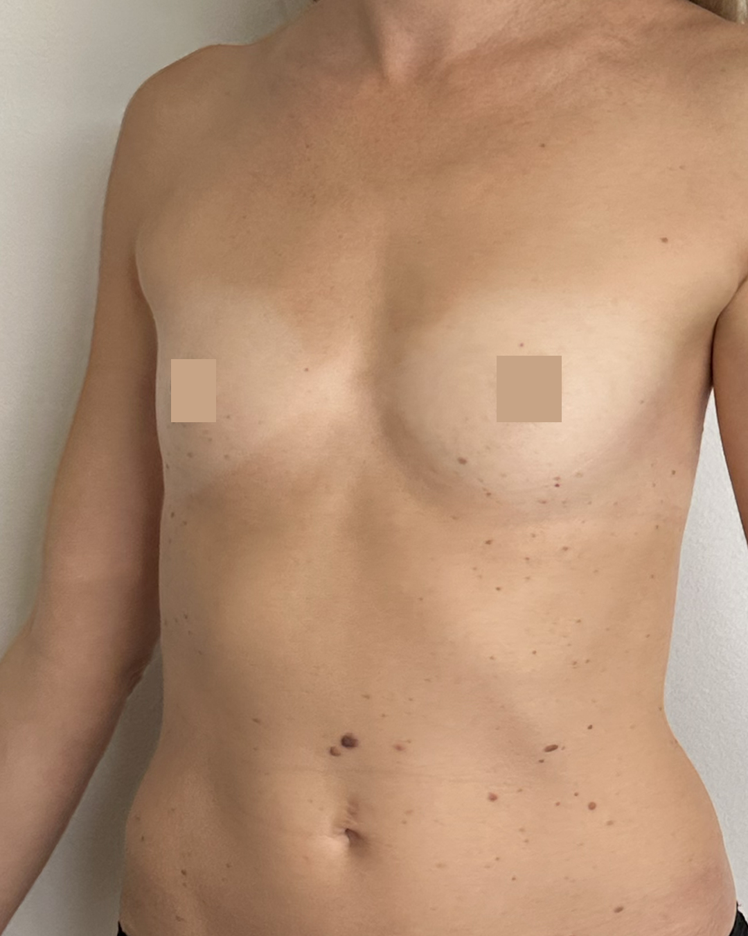 Avant apres augmentation mammaire composite lyon dr Mertens