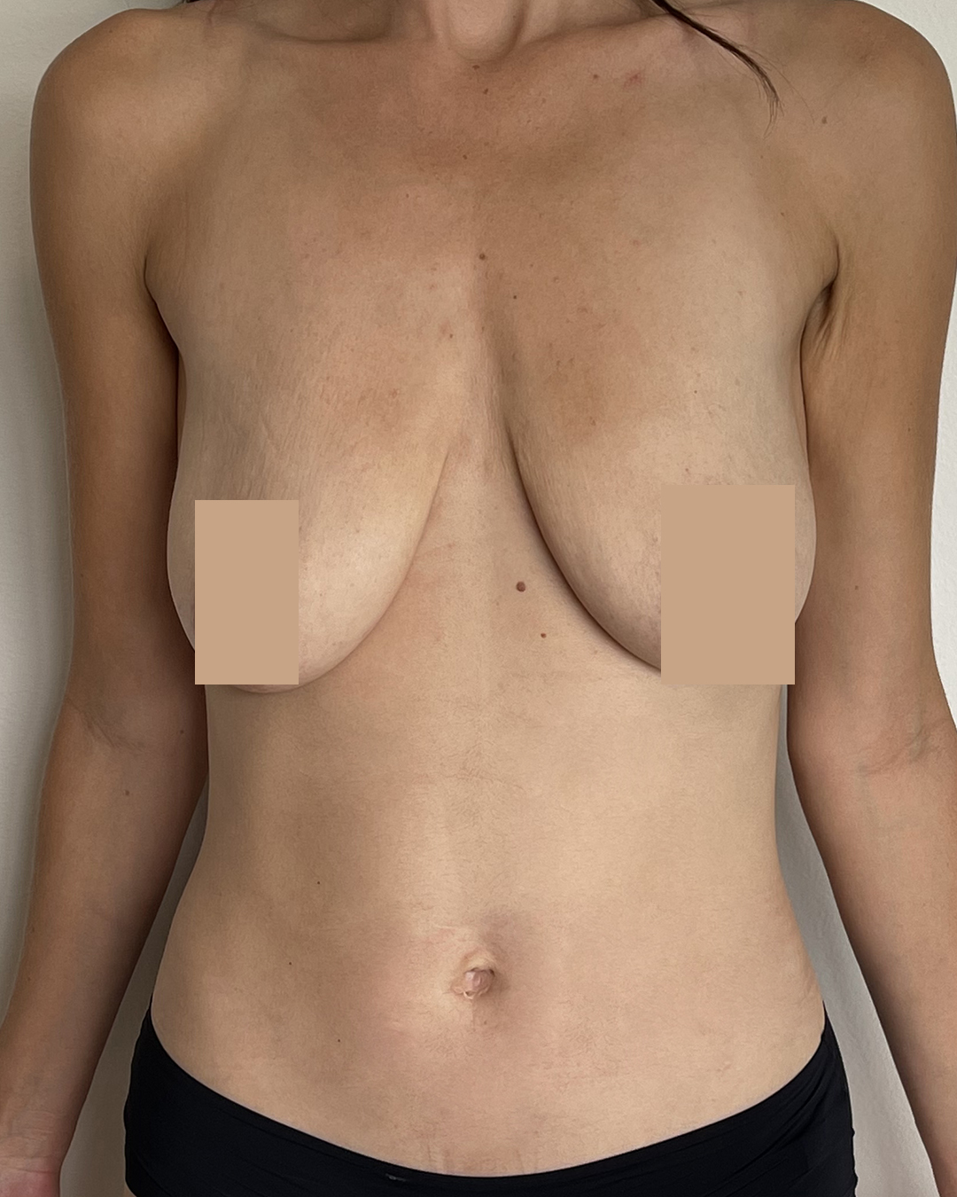 Avant Augmentation Mammaire & lifting des seins