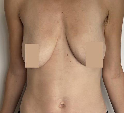 Avant Augmentation Mammaire & lifting des seins