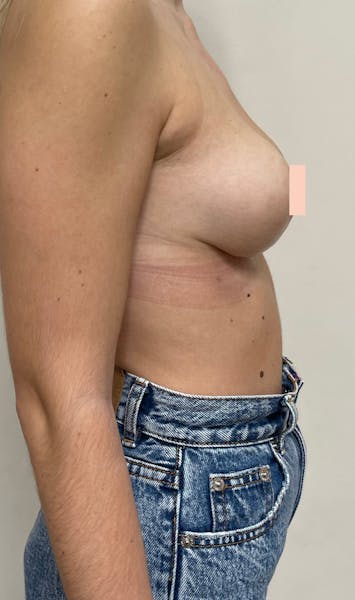 Lifting mammaire après