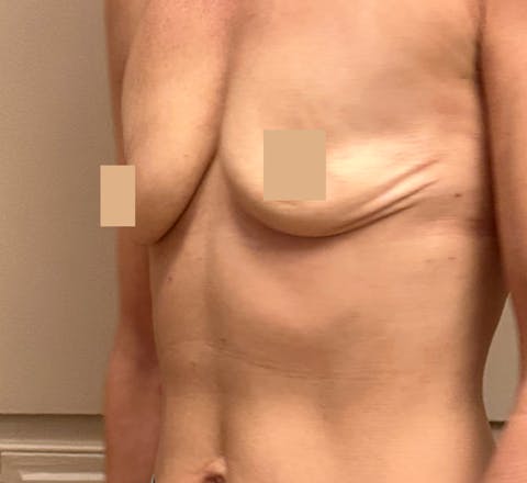 L’augmentation mammaire par prothèses après une grossesse avant