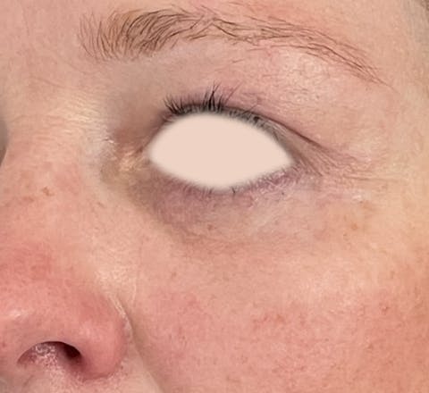 Blépharoplastie après