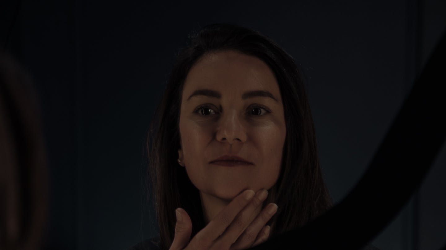 Résultats de radiofréquence microneedling par le Dr. Alexandre Mertens à Lyon Vienne