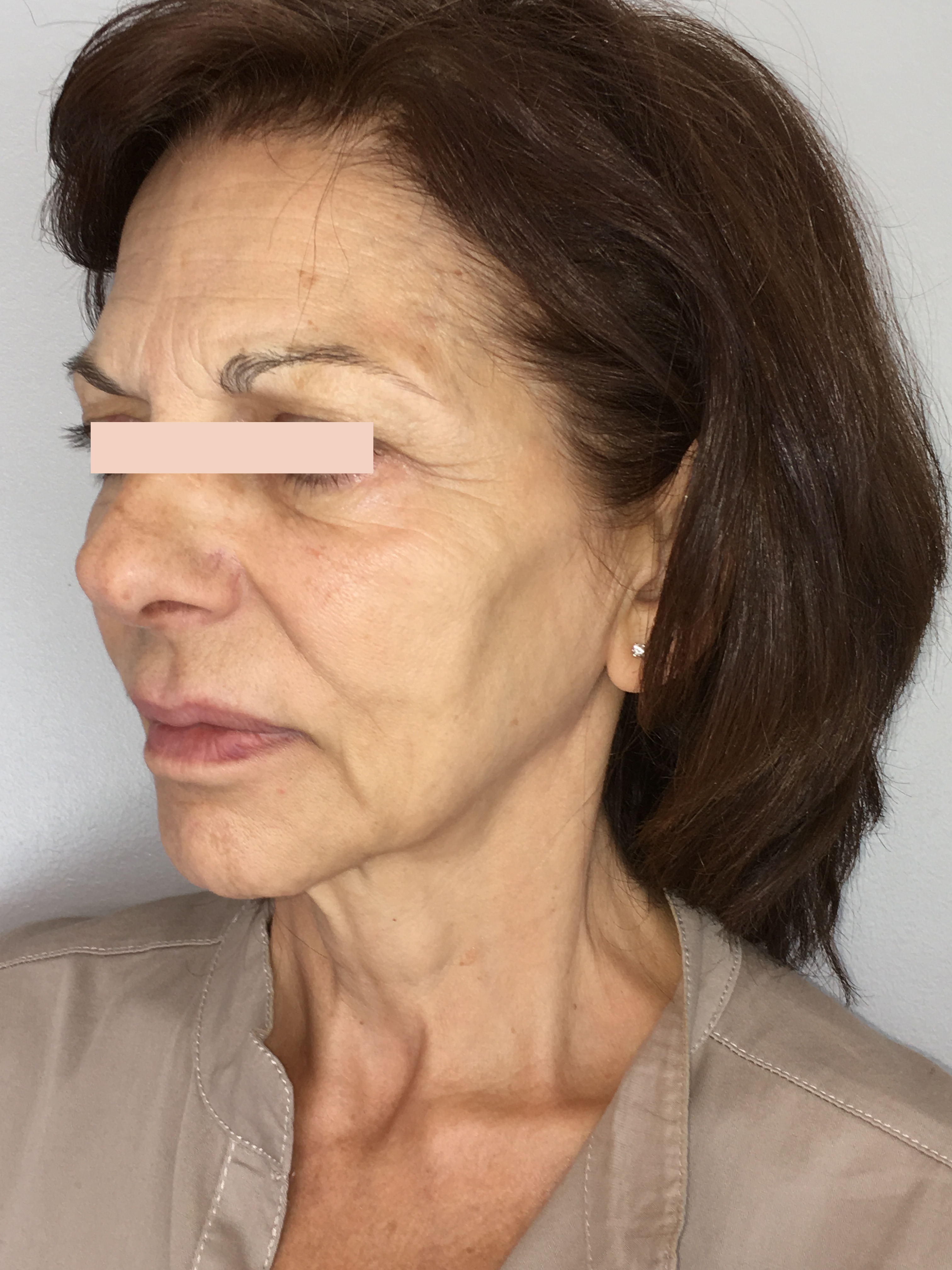 Lifting facial avant