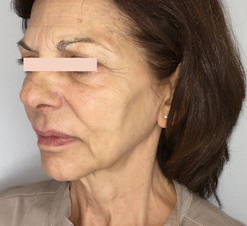 Lifting facial avant