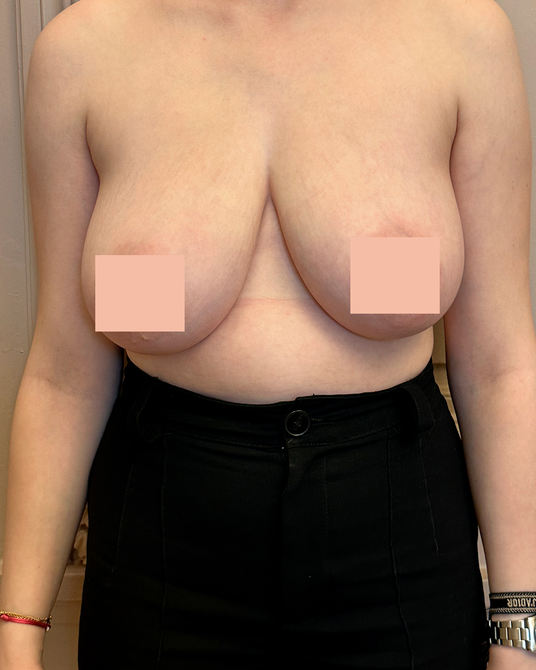Avant Réduction mammaire