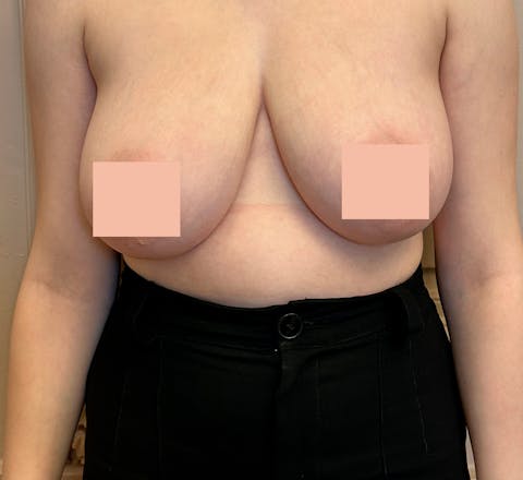 Avant Réduction mammaire