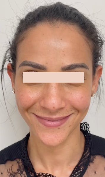 Après injections de botox au niveau des rides de la patte d'oie