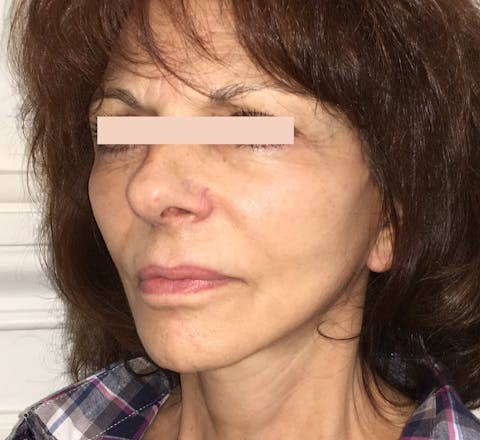 Lifting facial après