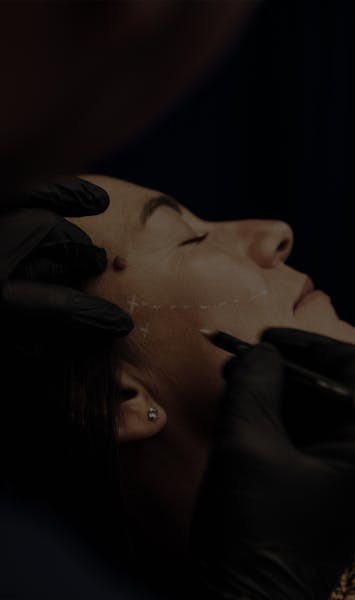 Fils tenseurs par le Dr. Alexandre Mertens