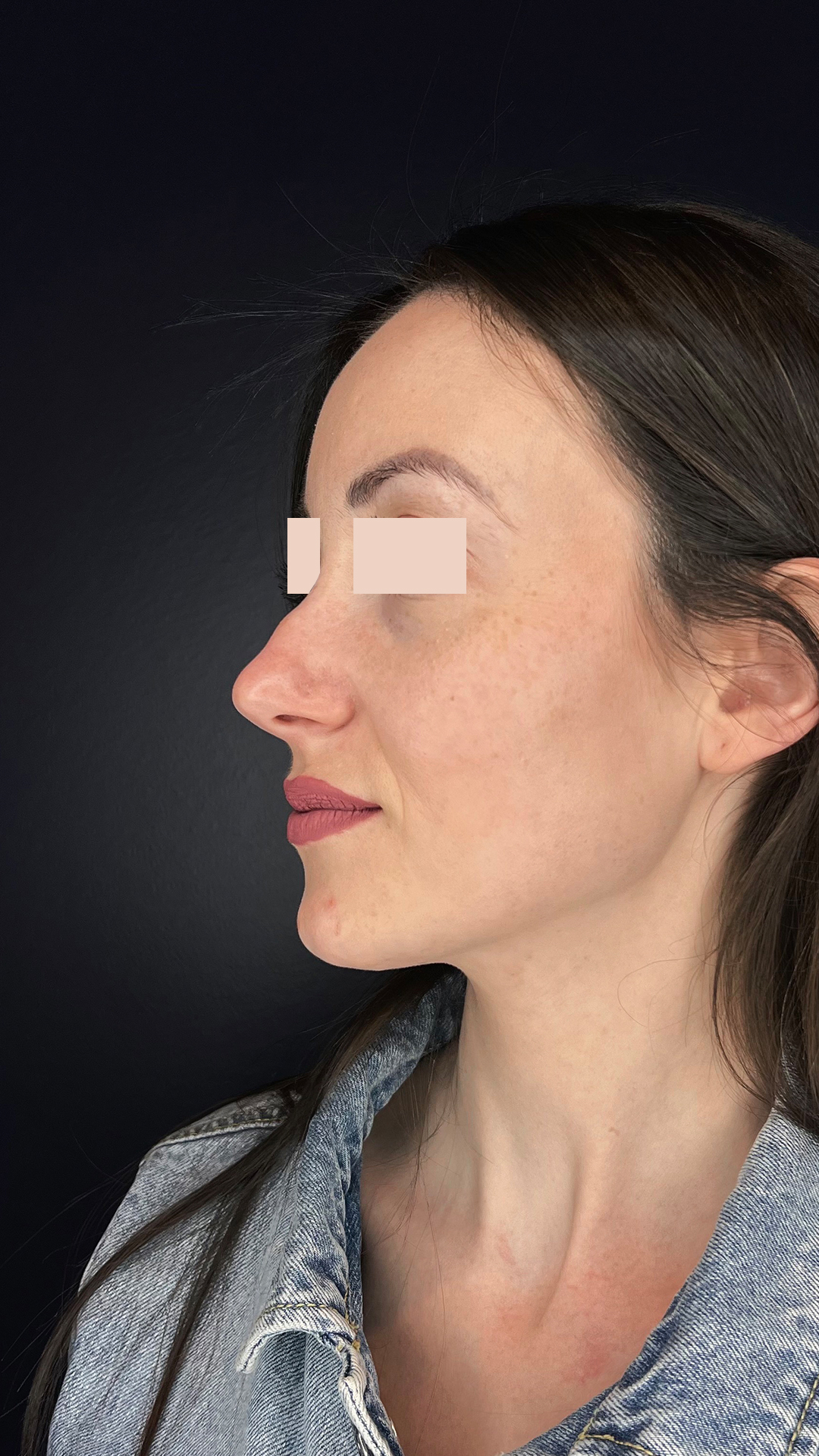 Rhinoplastie médicale avant