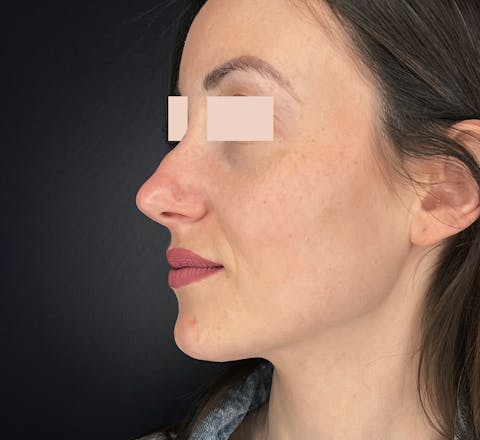 Rhinoplastie médicale avant