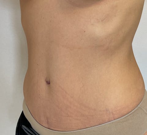 Abdominoplastie et lipoaspiration après