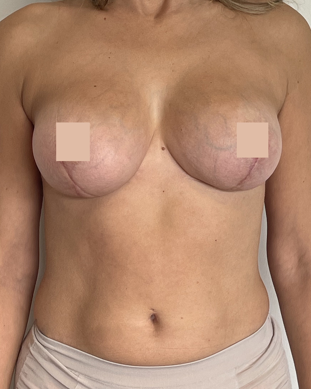 Après Augmentation Mammaire & lifting des seins