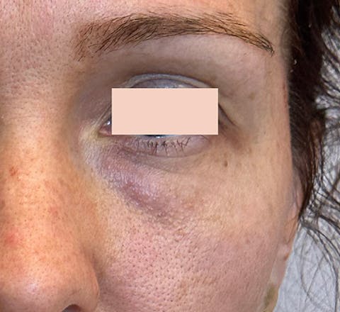 Chirurgie du regard avant