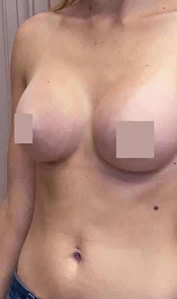 Avant apres augmentation mammaire dr mertens lyon vienne