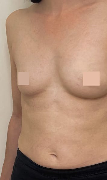 Augmentation mammaire par prothèses avant