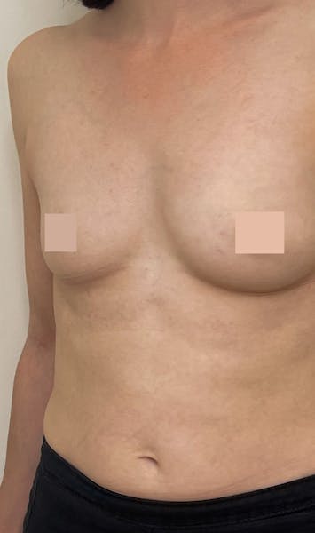 Pose de prothèses mammaires avant