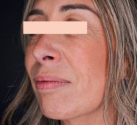 Lifting médical avant