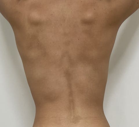 Cryolipolyse médicale après