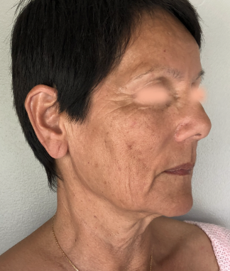 Lifting facial avant