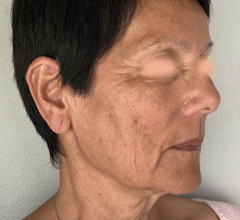 Lifting facial avant