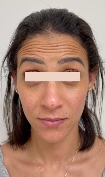 Injections de botox avant