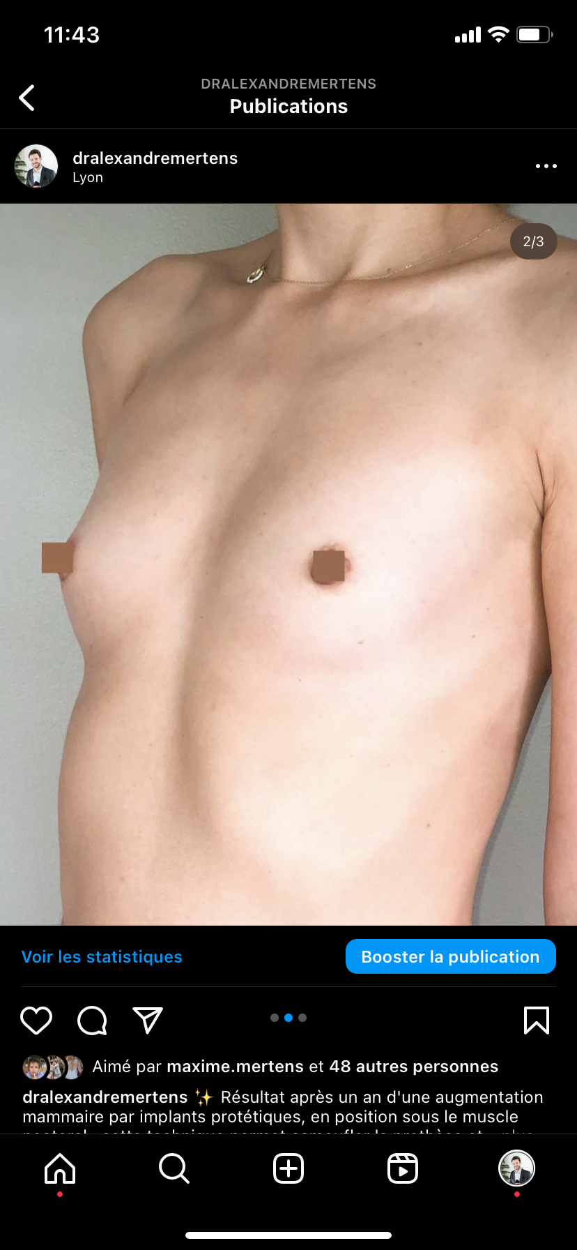 L’augmentation mammaire par implants protétiques avant