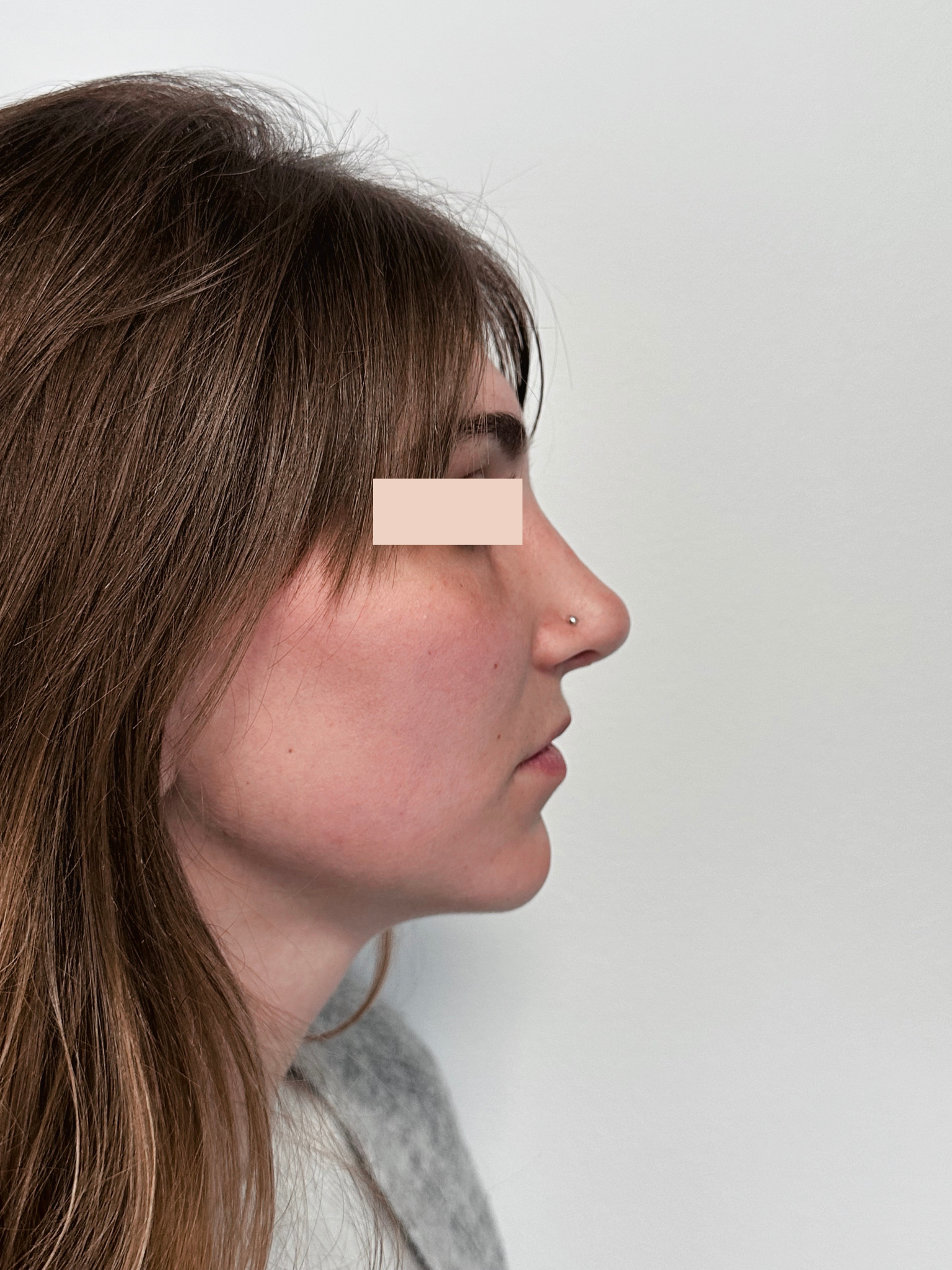 Après Rhinoplastie 