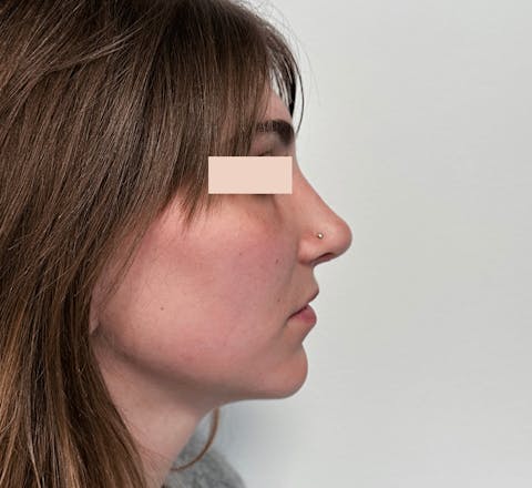 Après Rhinoplastie