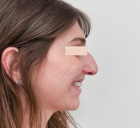 Avant Rhinoplastie
