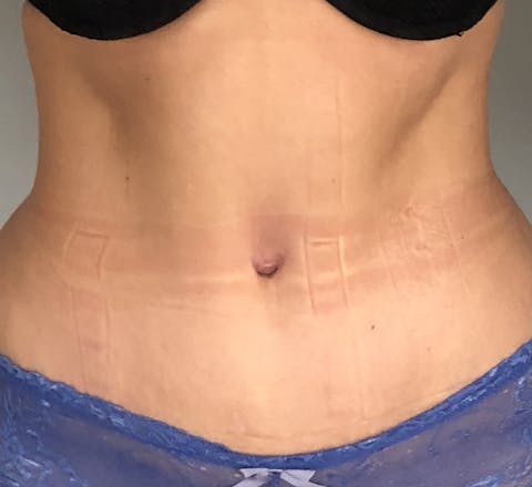Abdominoplastie après