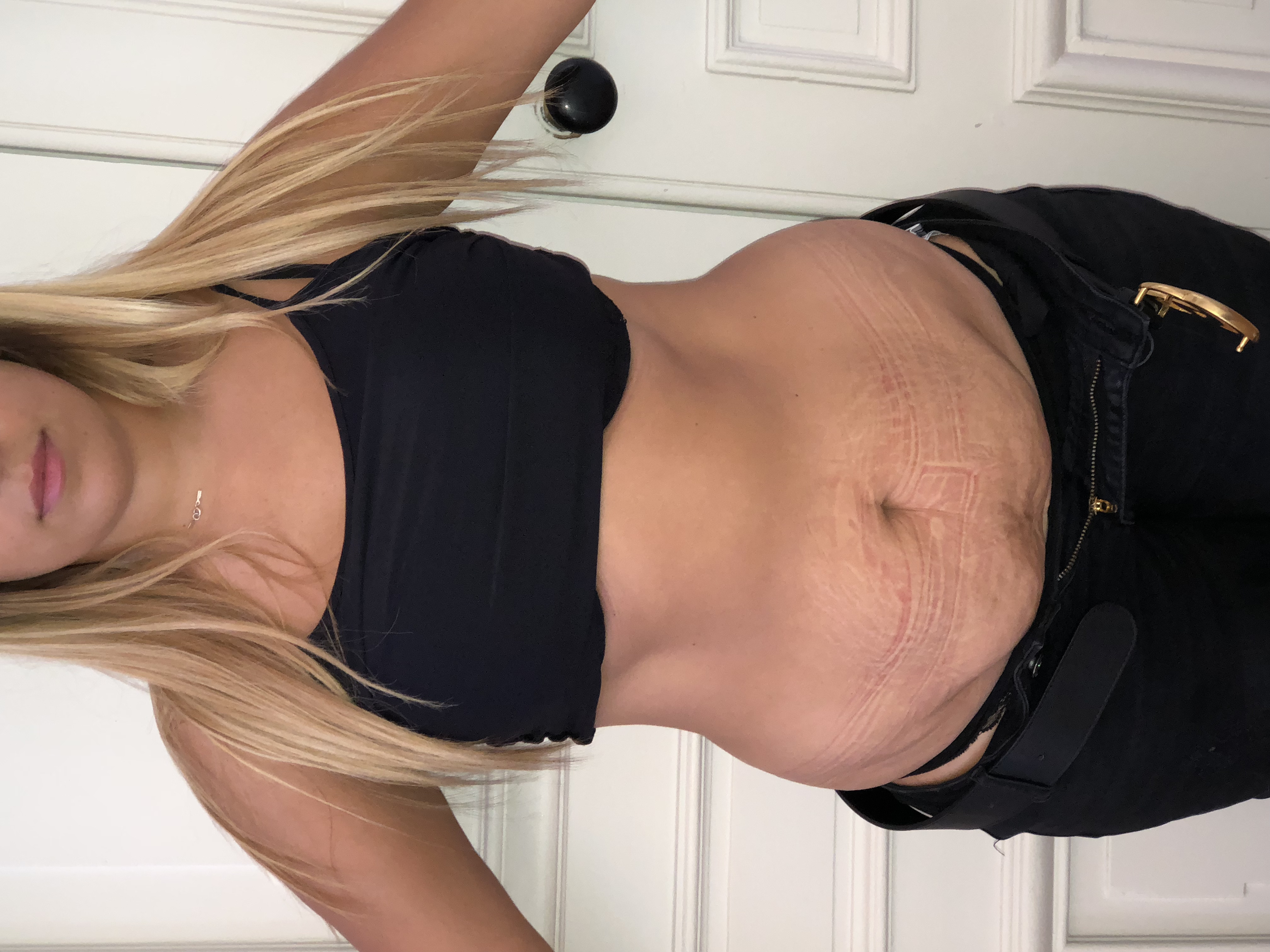 Abdominoplastie avant