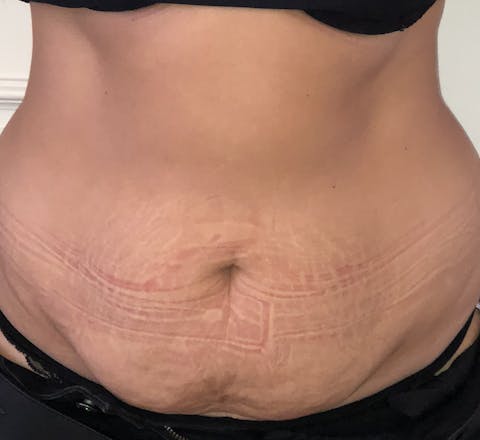Abdominoplastie avant