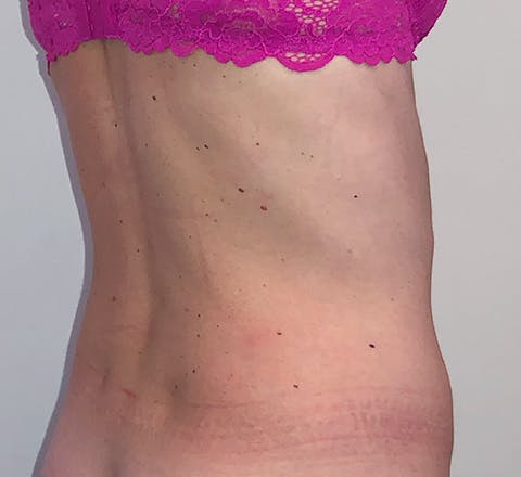 Cryolipolyse médicale du ventre après