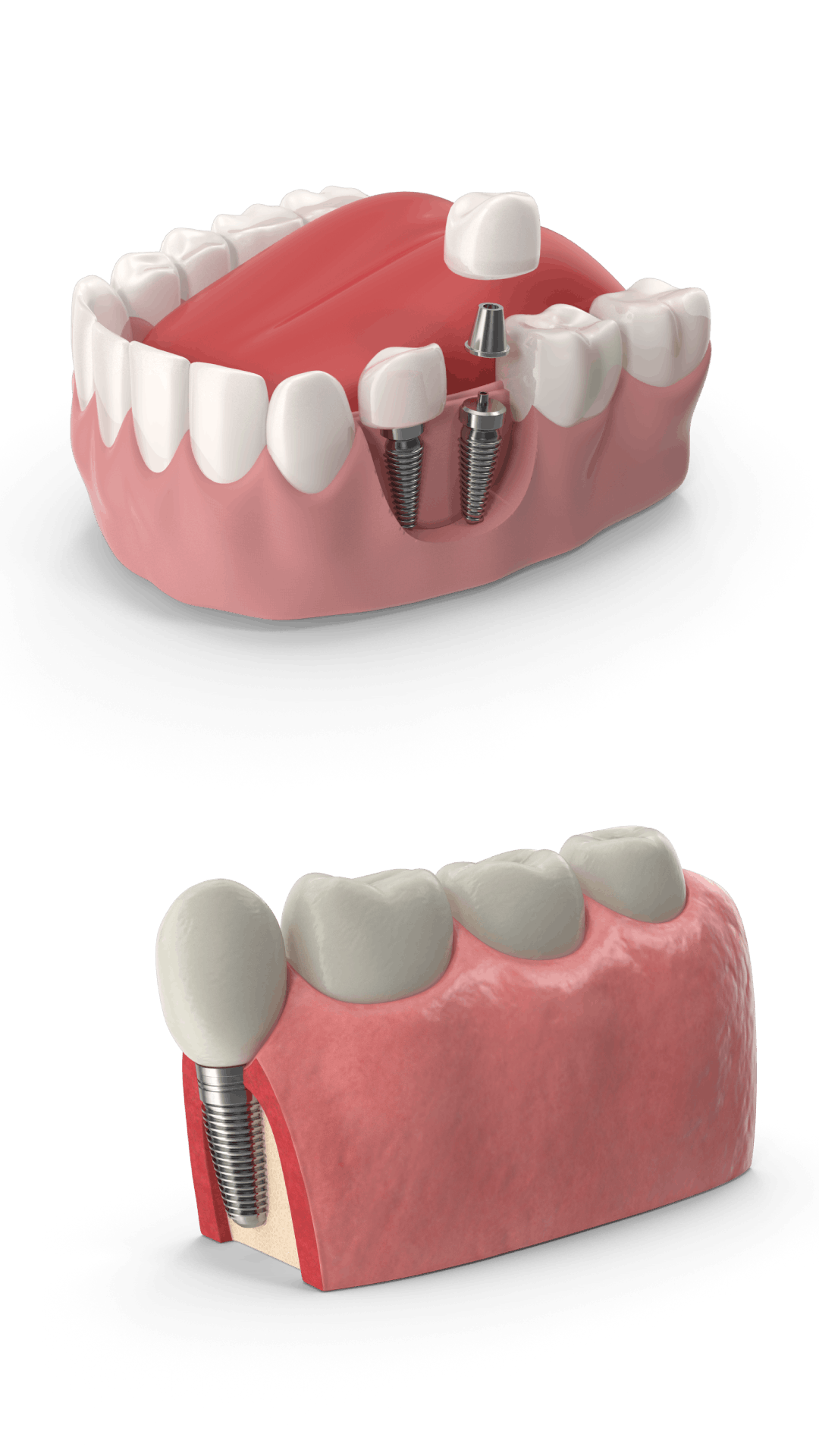 artificial tooth implant
