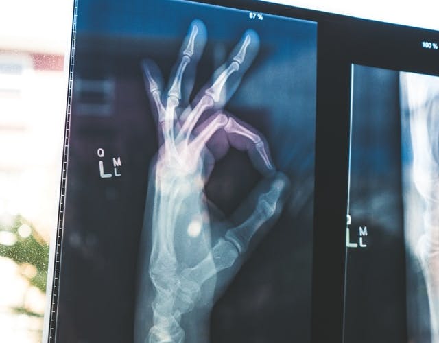 x-ray of a hand doing an 'OK'