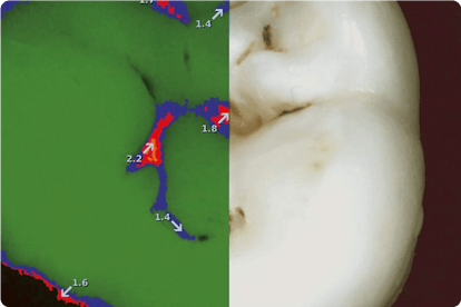 Früherkennung Karies