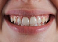 Descoloração dos dentes, dentes amarelos, dentes de escova brancos